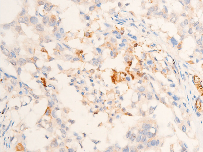 TGFB1 / TGF Beta 1 Antibody - 1:100 staining human lung carcinoma tissue by IHC-P. The tissue was formaldehyde fixed and a heat mediated antigen retrieval step in citrate buffer was performed. The tissue was then blocked and incubated with the antibody for 1.5 hours at 22°C. An HRP conjugated goat anti-rabbit antibody was used as the secondary.