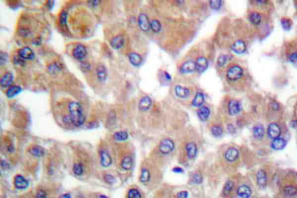 TGFB1 / TGF Beta 1 Antibody - IHC of TGF1 (Y369) pAb in paraffin-embedded human breast carcinoma tissue.
