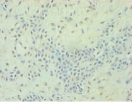 TGFB2 / TGF Beta2 Antibody - Immunohistochemistry of paraffin-embedded human breast cancer using antibody at 1:100 dilution.  This image was taken for the unconjugated form of this product. Other forms have not been tested.