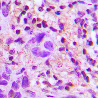 TGFB2 / TGF Beta2 Antibody - Immunohistochemical analysis of TGF beta 2 staining in human lung cancer formalin fixed paraffin embedded tissue section. The section was pre-treated using heat mediated antigen retrieval with sodium citrate buffer (pH 6.0). The section was then incubated with the antibody at room temperature and detected using an HRP conjugated compact polymer system. DAB was used as the chromogen. The section was then counterstained with hematoxylin and mounted with DPX.