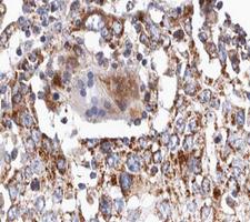 TGFB2 / TGF Beta2 Antibody - 1:100 staining human lung carcinoma tissue by IHC-P. The tissue was formaldehyde fixed and a heat mediated antigen retrieval step in citrate buffer was performed. The tissue was then blocked and incubated with the antibody for 1.5 hours at 22°C. An HRP conjugated goat anti-rabbit antibody was used as the secondary.