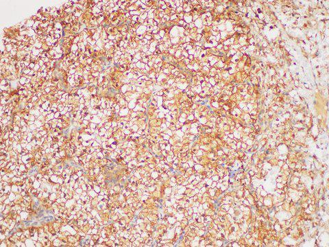 TGFB2 / TGF Beta2 Antibody - Immunohistochemistry of paraffin-embedded Human clear cell carcinoma of kidney using TGFB2 Polycloanl Antibody at dilution of 1:200.