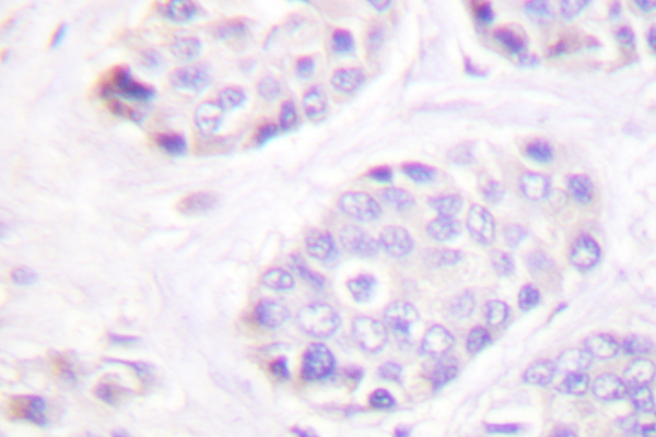 TGFB3 / TGF Beta3 Antibody - IHC of TGF 3 (G292) pAb in paraffin-embedded human breast carcinoma tissue.