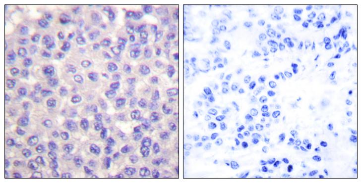 TGFB3 / TGF Beta3 Antibody - Peptide - + Immunohistochemical analysis of paraffin-embedded human breast carcinoma tissue using TGF ß3 antibody.