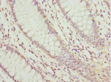 TGFB4 / LEFTY2 Antibody - Immunohistochemistry of paraffin-embedded human colon cancer at dilution 1:100