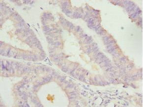 TGFB4 / LEFTY2 Antibody - Immunohistochemistry of paraffin-embedded human endometrial cancer at dilution 1:100