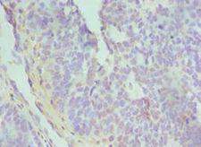 TGFBI Antibody - Immunohistochemistry of paraffin-embedded human endometrial cancer using antibody at 1:100 dilution.