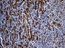 TGFBI Antibody - Immunohistochemical staining of paraffin-embedded Human lymphoma tissue using anti-TGFBI mouse monoclonal antibody. (Heat-induced epitope retrieval by 1mM EDTA in 10mM Tris buffer. (pH8.5) at 120°C for 3 min. (1:500)