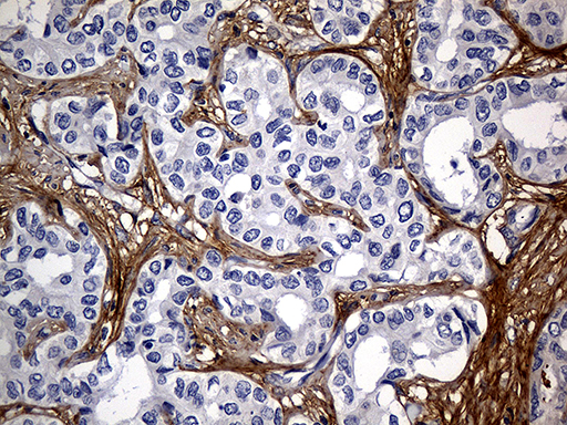 TGFBI Antibody - Immunohistochemical staining of paraffin-embedded Carcinoma of Human liver tissue using anti-TGFBI mouse monoclonal antibody. (Heat-induced epitope retrieval by 1mM EDTA in 10mM Tris buffer. (pH8.5) at 120°C for 3 min. (1:500)