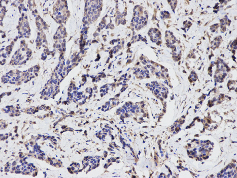 TGFBI Antibody - Immunohistochemistry of paraffin-embedded human breast cancer using TGFBI antibody at dilution of 1:100 (200x lens).