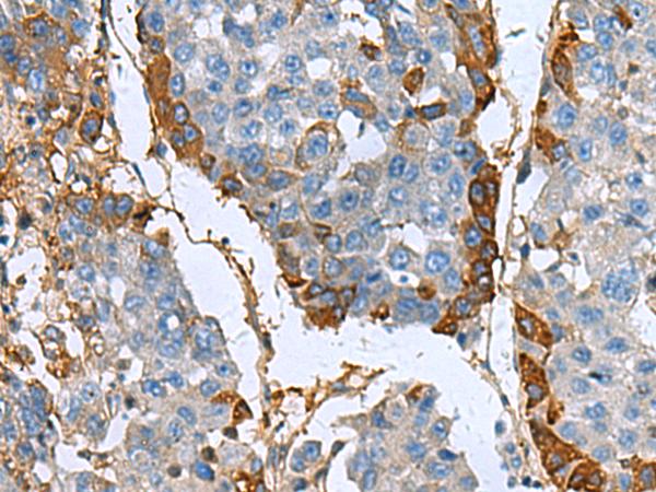 TGFBI Antibody - Immunohistochemistry of paraffin-embedded Human liver cancer tissue  using TGFBI Polyclonal Antibody at dilution of 1:60(×200)