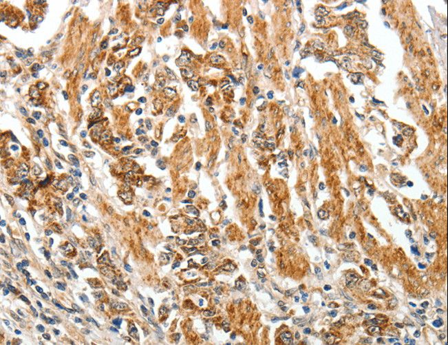 TGFBR1 / ALK5 Antibody - Immunohistochemistry of paraffin-embedded Human gastric cancer using TGFBR1 Polyclonal Antibody at dilution of 1:60.