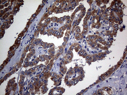TGFBR2 Antibody - Immunohistochemical staining of paraffin-embedded Carcinoma of Human thyroid tissue using anti-TGFBR2 mouse monoclonal antibody. (Heat-induced epitope retrieval by 1mM EDTA in 10mM Tris buffer. (pH8.5) at 120°C for 3 min. (1:2000)