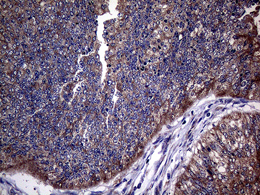 TGFBR2 Antibody - Immunohistochemical staining of paraffin-embedded Adenocarcinoma of Human colon tissue using anti-TGFBR2 mouse monoclonal antibody. (Heat-induced epitope retrieval by 1mM EDTA in 10mM Tris buffer. (pH8.5) at 120°C for 3 min. (1:2000)