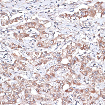 TGFBR2 Antibody - Immunohistochemistry of paraffin-embedded human liver cancer using TGFBR2 antibody at dilution of 1:100 (40x lens).