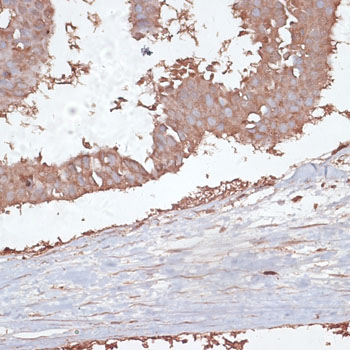TGFBR2 Antibody - Immunohistochemistry of paraffin-embedded human mammary cancer using TGFBR2 antibody at dilution of 1:100 (40x lens).
