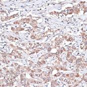 TGFBR2 Antibody - Immunohistochemistry of paraffin-embedded Human liver cancer using TGFBR2 Polyclonal Antibody at dilution of 1:100 (40x lens).