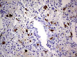 TGIF1 Antibody - IHC of paraffin-embedded Carcinoma of Human lung tissue using anti-TGIF1 mouse monoclonal antibody. (Heat-induced epitope retrieval by 10mM citric buffer, pH6.0, 120°C for 3min).