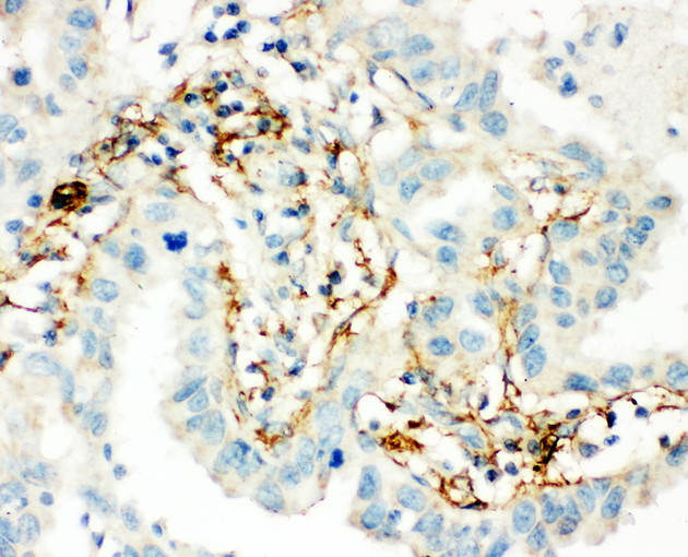 TGM2 / Transglutaminase 2 Antibody - TGM2 / Transglutaminase 2 antibody. IHC(P): Human Lung Cancer Tissue.