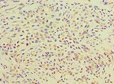 TGM2 / Transglutaminase 2 Antibody - Immunohistochemistry of paraffin-embedded human breast cancer using antibody at 1:100 dilution.