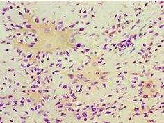 TGM2 / Transglutaminase 2 Antibody - Immunohistochemistry of paraffin-embedded human breast cancer using antibody at 1:100 dilution.