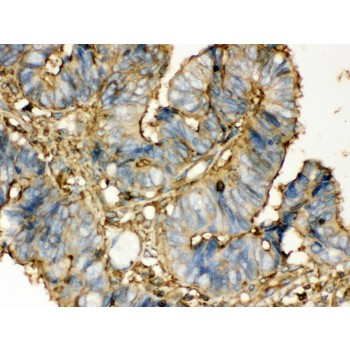 TGM2 / Transglutaminase 2 Antibody - TGM2 antibody IHC-paraffin. IHC(P): Human Intestinal Cancer Tissue.