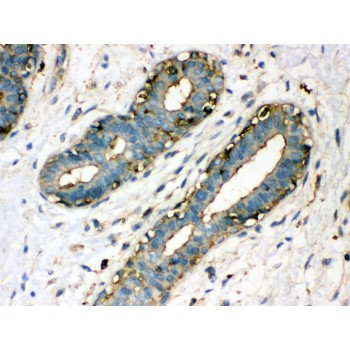 TGM2 / Transglutaminase 2 Antibody - TGM2 antibody IHC-paraffin. IHC(P): Human Mammary Cancer Tissue.