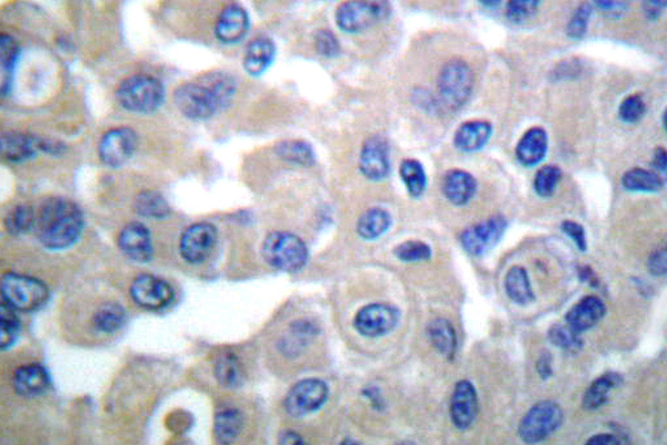 TGM2 / Transglutaminase 2 Antibody - IHC of Transglutaminase 2 (D11) pAb in paraffin-embedded human breast carcinoma tissue.