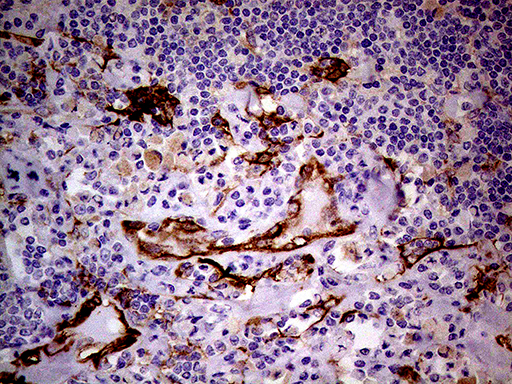 TGM2 / Transglutaminase 2 Antibody - Immunohistochemical staining of paraffin-embedded Human lymphoma tissue using anti-TGM2 mouse monoclonal antibody. (Heat-induced epitope retrieval by 1mM EDTA in 10mM Tris buffer. (pH8.5) at 120°C for 3 min. (1:500)
