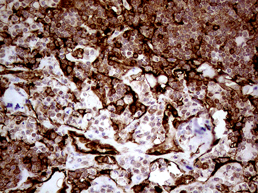 TGM2 / Transglutaminase 2 Antibody - Immunohistochemical staining of paraffin-embedded Human lymphoma tissue using anti-TGM2 mouse monoclonal antibody. (Heat-induced epitope retrieval by 1mM EDTA in 10mM Tris buffer. (pH8.5) at 120°C for 3 min. (1:500)