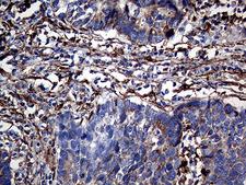 TGM2 / Transglutaminase 2 Antibody - Immunohistochemical staining of paraffin-embedded Carcinoma of Human lung tissue using anti-TGM2 mouse monoclonal antibody. (Heat-induced epitope retrieval by 1mM EDTA in 10mM Tris buffer. (pH8.5) at 120°C for 3 min. (1:1000)