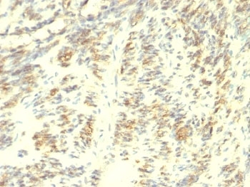 TGM2 / Transglutaminase 2 Antibody - Formalin-fixed, paraffin-embedded human Leiomyosarcoma stained with Transglutaminase 2 antibody.  This image was taken for the unmodified form of this product. Other forms have not been tested.