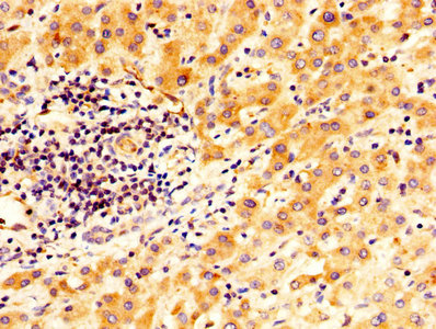 TGM2 / Transglutaminase 2 Antibody - IHC image of TGM2 Antibody diluted at 1:400 and staining in paraffin-embedded human liver cancer performed on a Leica BondTM system. After dewaxing and hydration, antigen retrieval was mediated by high pressure in a citrate buffer (pH 6.0). Section was blocked with 10% normal goat serum 30min at RT. Then primary antibody (1% BSA) was incubated at 4°C overnight. The primary is detected by a biotinylated secondary antibody and visualized using an HRP conjugated SP system.