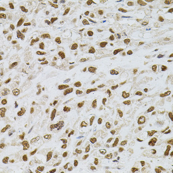 TGM2 / Transglutaminase 2 Antibody - Immunohistochemistry of paraffin-embedded human lung cancer using TGM2 antibody(40x lens).