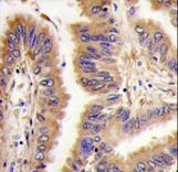 TGM2 / Transglutaminase 2 Antibody - Formalin-fixed and paraffin-embedded human lung carcinoma tissue reacted with *TGM2 antibody (Center K444), which was peroxidase-conjugated to the secondary antibody, followed by DAB staining. This data demonstrates the use of this antibody for immunohistochemistry; clinical relevance has not been evaluated.