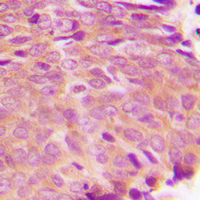 TGM2 / Transglutaminase 2 Antibody - Immunohistochemical analysis of Transglutaminase 2 staining in human breast cancer formalin fixed paraffin embedded tissue section. The section was pre-treated using heat mediated antigen retrieval with sodium citrate buffer (pH 6.0). The section was then incubated with the antibody at room temperature and detected using an HRP conjugated compact polymer system. DAB was used as the chromogen. The section was then counterstained with hematoxylin and mounted with DPX.