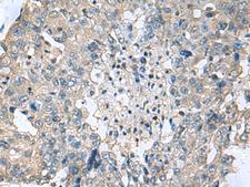 TGM3 / Transglutaminase 3 Antibody - Immunohistochemistry of paraffin-embedded Human liver cancer tissue  using TGM3 Polyclonal Antibody at dilution of 1:55(×200)