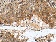 TGM3 / Transglutaminase 3 Antibody - Immunohistochemistry of paraffin-embedded Human liver cancer tissue  using TGM3 Polyclonal Antibody at dilution of 1:110(×200)