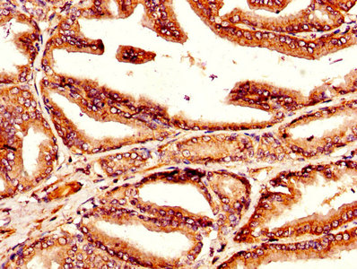 TGM4 / Transglutaminase 4 Antibody - IHC image of TGM4 Antibody diluted at 1:300 and staining in paraffin-embedded human prostate tissue performed on a Leica BondTM system. After dewaxing and hydration, antigen retrieval was mediated by high pressure in a citrate buffer (pH 6.0). Section was blocked with 10% normal goat serum 30min at RT. Then primary antibody (1% BSA) was incubated at 4°C overnight. The primary is detected by a biotinylated secondary antibody and visualized using an HRP conjugated SP system.