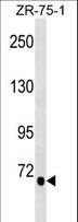 TGM5 / Transglutaminase 5 Antibody - TGM5 Antibody western blot of ZR-75-1 cell line lysates (35 ug/lane). The TGM5 antibody detected the TGM5 protein (arrow).