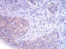 TH / Tyrosine Hydroxylase Antibody - Immunohistochemical analysis of paraffin-embedded cervical cancer tissues using TH mouse mAb with DAB staining.