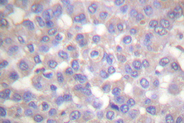 TH / Tyrosine Hydroxylase Antibody - IHC of Tyrosine Hydroxylase (Q25) pAb in paraffin-embedded human breast carcinoma tissue.