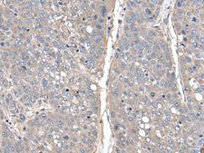 THAP10 Antibody - Immunohistochemistry of paraffin-embedded Human liver cancer tissue  using THAP10 Polyclonal Antibody at dilution of 1:40(×200)