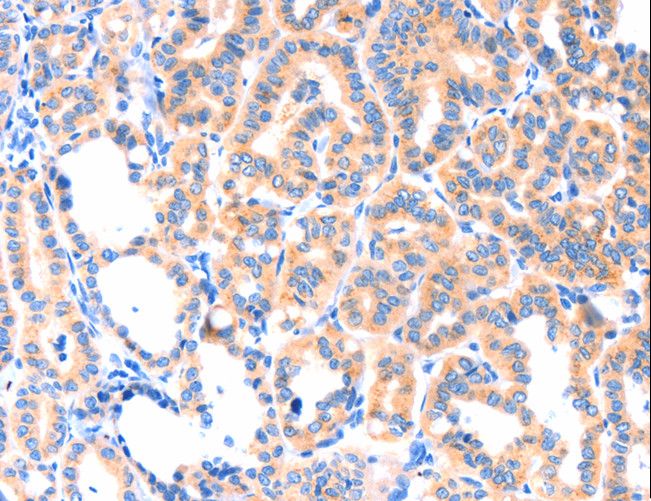THBS1 / Thrombospondin-1 Antibody - Immunohistochemistry of paraffin-embedded Human thyroid cancer using THBS1 Polyclonal Antibody at dilution of 1:50.