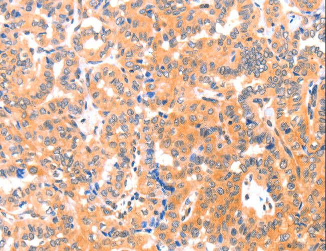 THBS1 / Thrombospondin-1 Antibody - Immunohistochemistry of paraffin-embedded Human cervical cancer using THBS1 Polyclonal Antibody at dilution of 1:60.