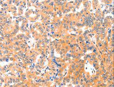 THBS1 / Thrombospondin-1 Antibody - Immunohistochemistry of paraffin-embedded Human cervical cancer using THBS1 Polyclonal Antibody at dilution of 1:60.