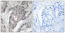 THBS4 / Thrombospondin 4 Antibody - Immunohistochemistry analysis of paraffin-embedded human breast carcinoma, using THBS4 Antibody. The picture on the right is blocked with the synthesized peptide.
