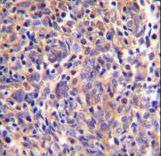 THEMIS / SPOT Antibody - THEMIS Antibody immunohistochemistry of formalin-fixed and paraffin-embedded human thymoma followed by peroxidase-conjugated secondary antibody and DAB staining.