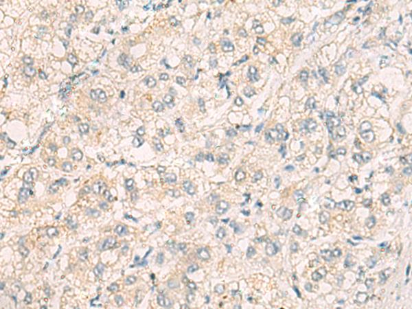 THG1L Antibody - Immunohistochemistry of paraffin-embedded Human liver cancer tissue  using THG1L Polyclonal Antibody at dilution of 1:70(×200)