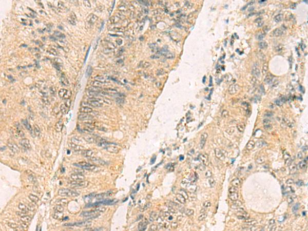 THG1L Antibody - Immunohistochemistry of paraffin-embedded Human colorectal cancer tissue  using THG1L Polyclonal Antibody at dilution of 1:70(×200)